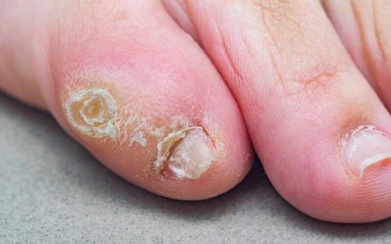 نگاهی به تفاوت‌های میخچه پا و زگیل/چگونه از ایجاد میخچه جلوگیری کنیم؟