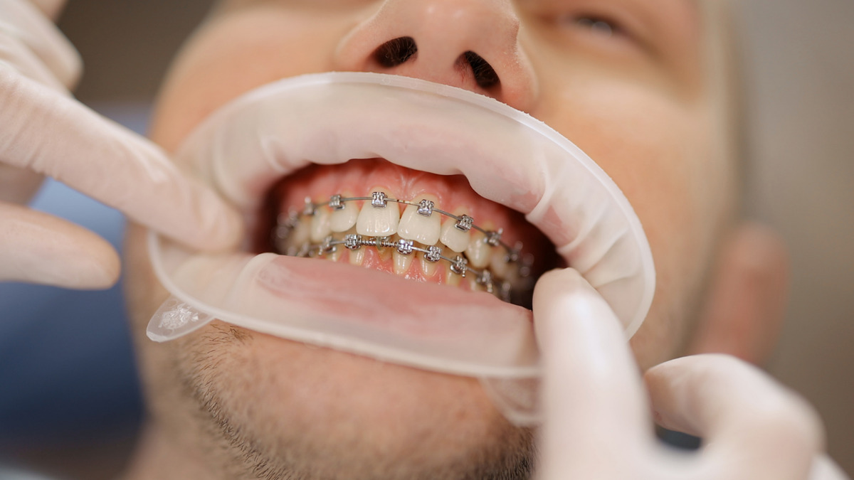 ارتودنسی ثابت دو فک چگونه انجام میشود؟