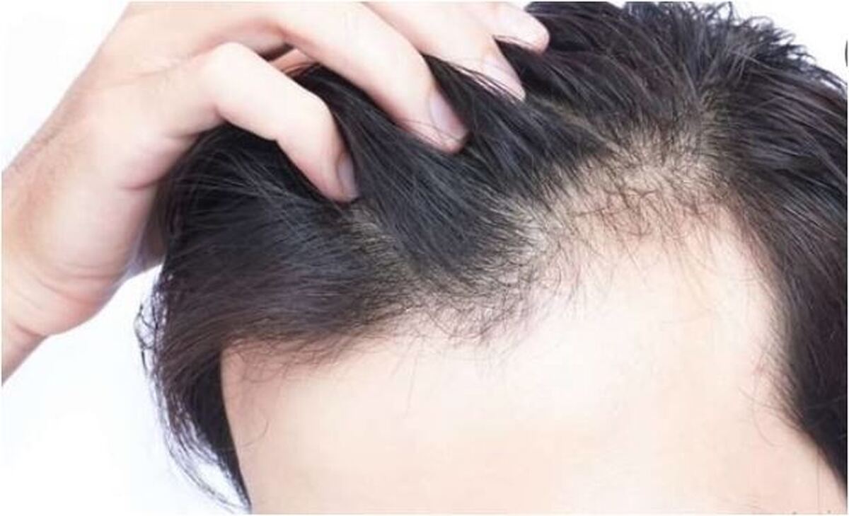 ساده‌ترین راه برای قطع ریزش مو‌ها