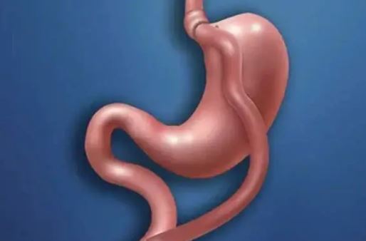 اگر قصد جراحی بای پس معده دارید حتما بخوانید/مزایا+معایب