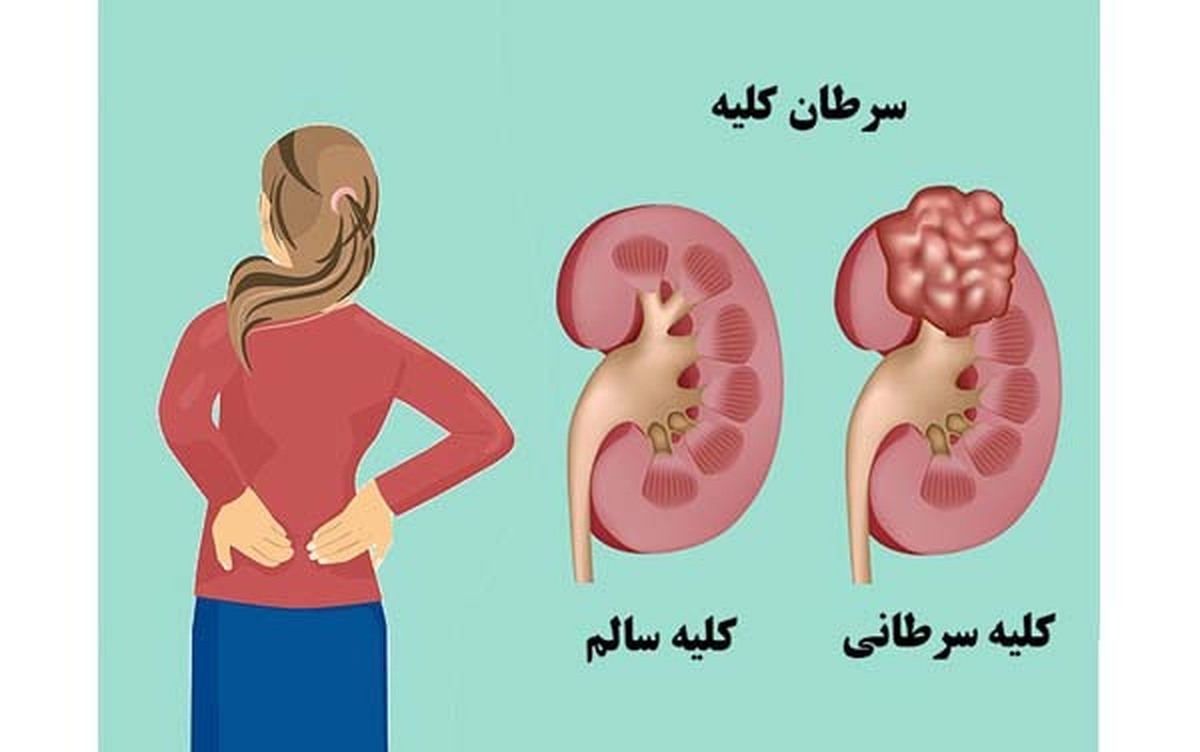 چه عواملی باعث افزایش سرطان کلیه میشود؟