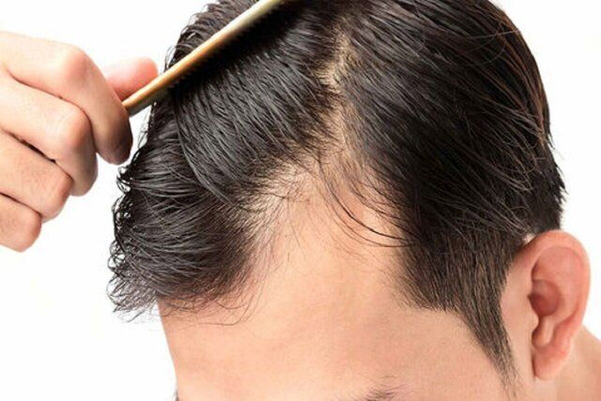 مشکلات روانی چگونه باعث ریزش مو میشوند؟