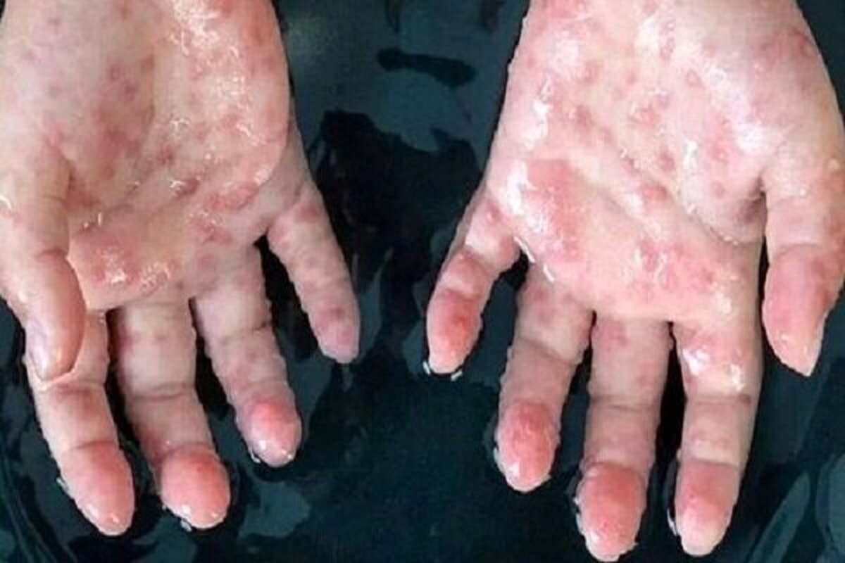 آبله میمون به شمال شرق انگلیس رسید!