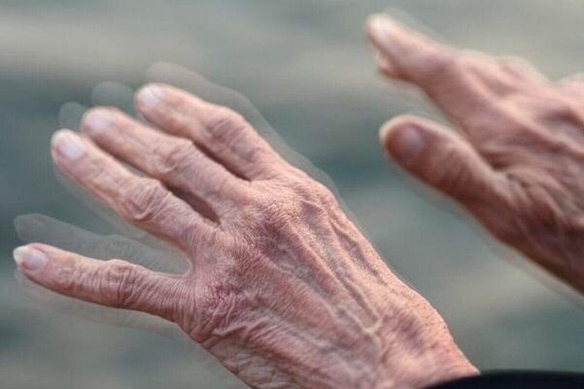 پارکینسون، اختلال مزمن مغزی با علائم متنوع و درمان‌های نوین