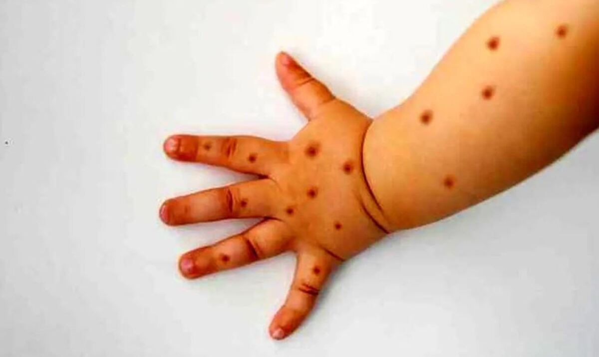 کاندیدای مبتلا شدن به آبله مرغان چه افرادی هستند؟