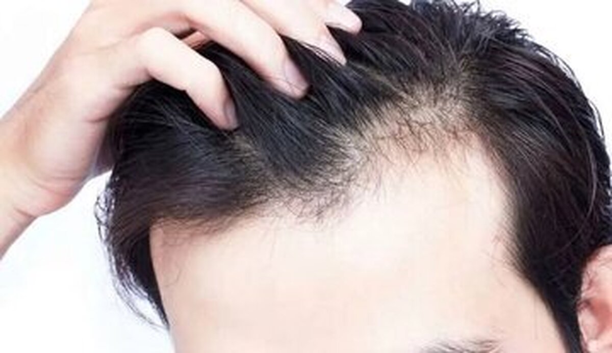 اگر از ریزش مو رنج می‌برید از مصرف این مواد غذایی غافل نشوید