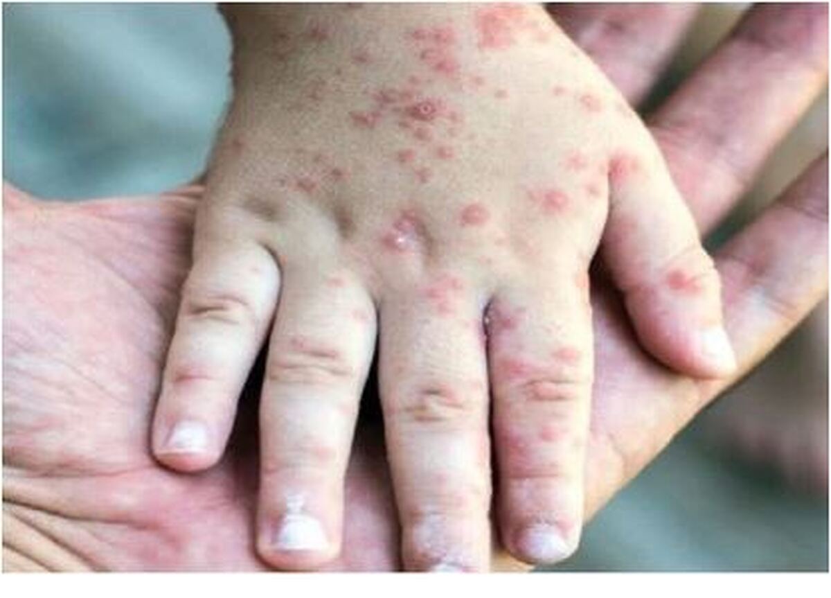 آخرین آمار اعلام شده از تعداد مبتلایان به سرخک در ایران
