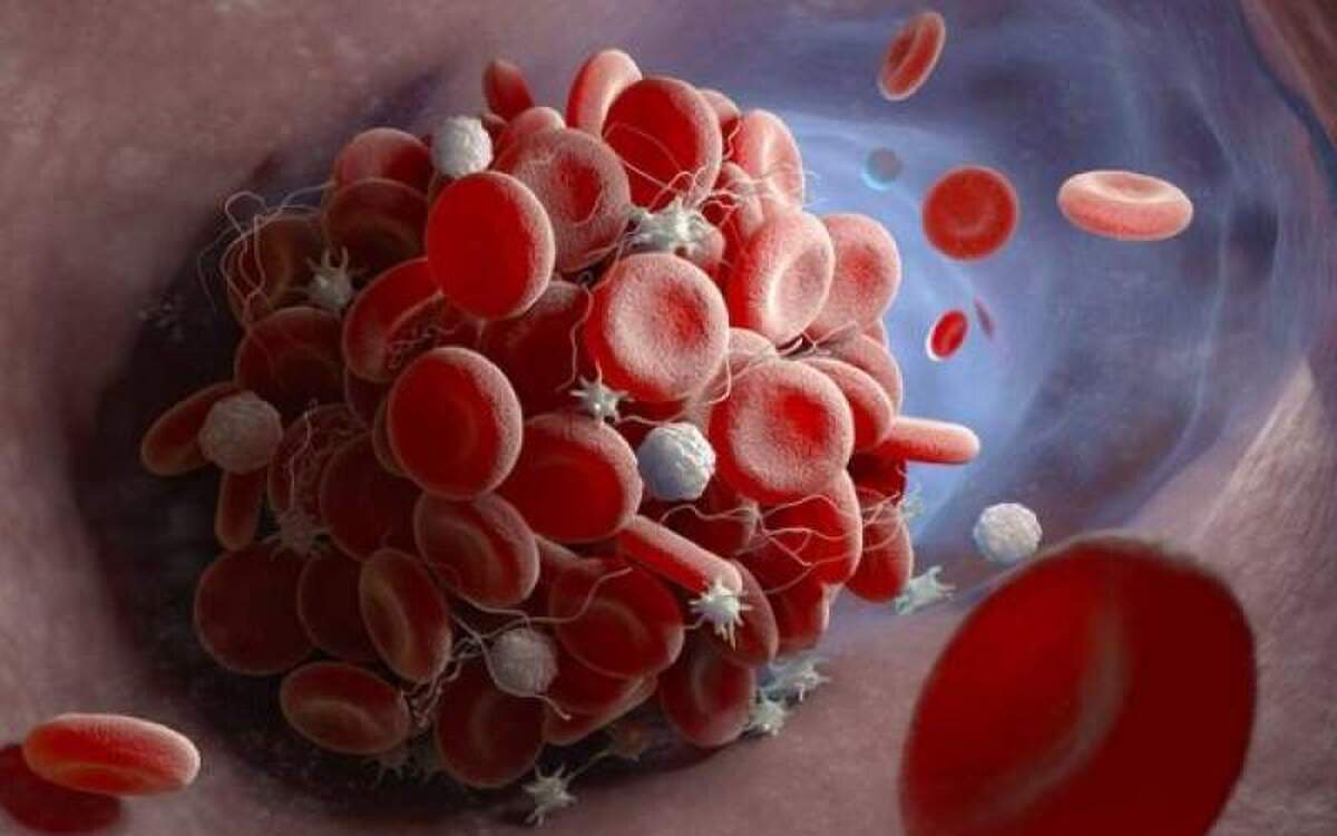سطح پلاکت خون پایین چه مشکلاتی ایجاد میکند؟