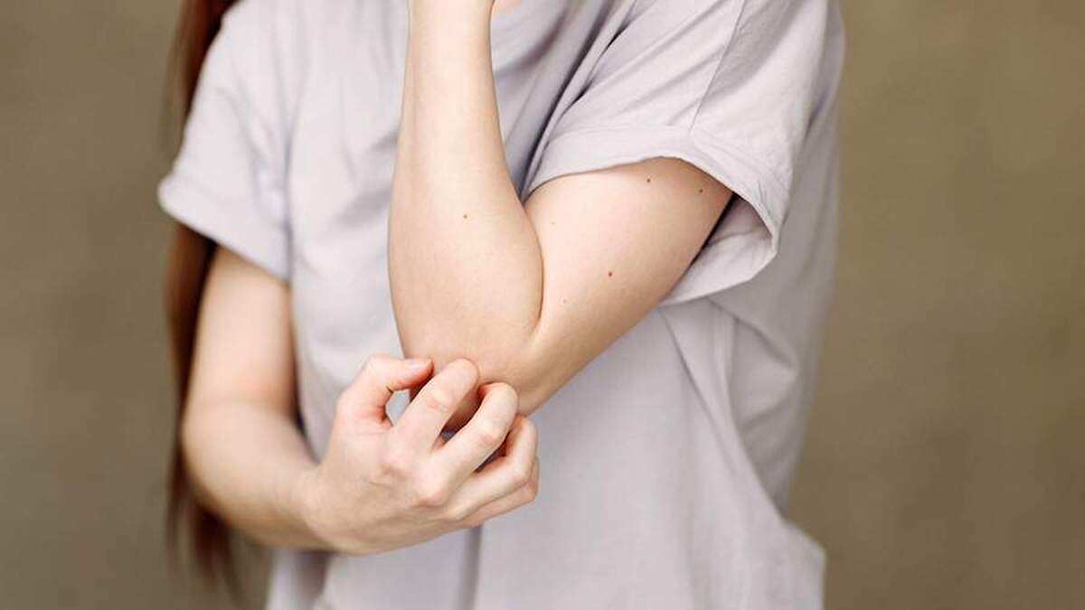 دیلی میل از شیوع گال بسیار عفونی در بریتانیا خبر داد