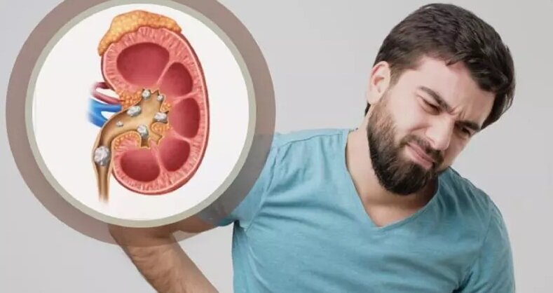 خوراکی‌هایی که برای سنگ کلیه نگرفتن باید از آنها دوری کنید