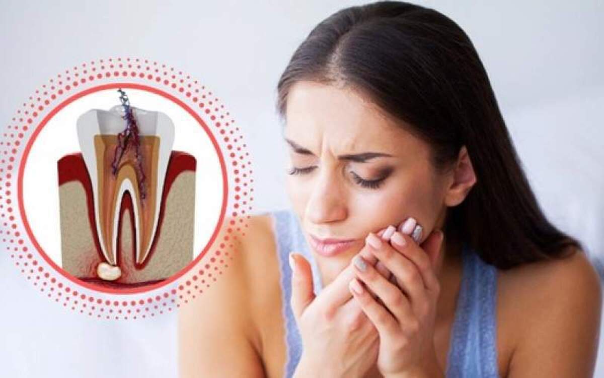 عصب کشی چیست؟ چه زمانی انجام میشود؟