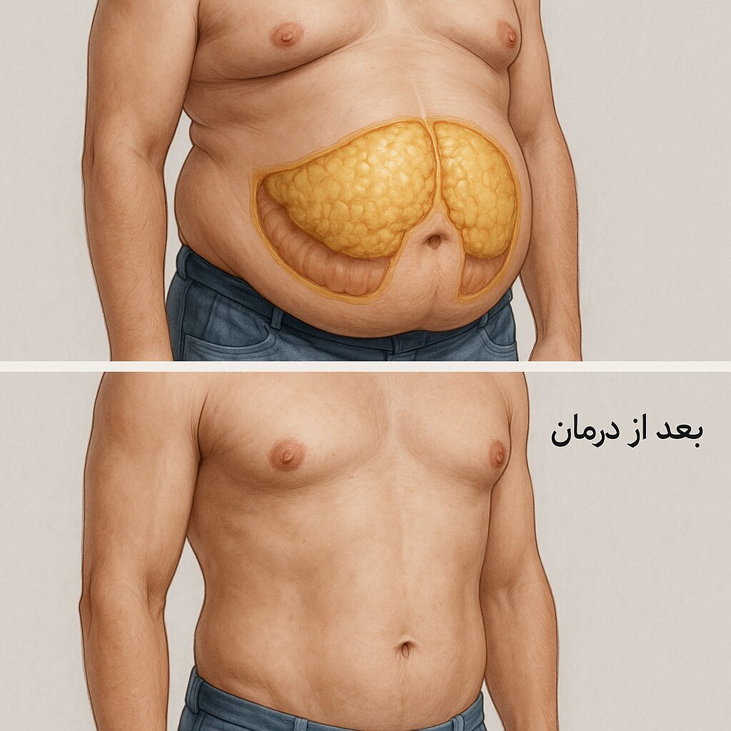 «شکم کورتیزولی» چیست؟ راه درمان دارد؟