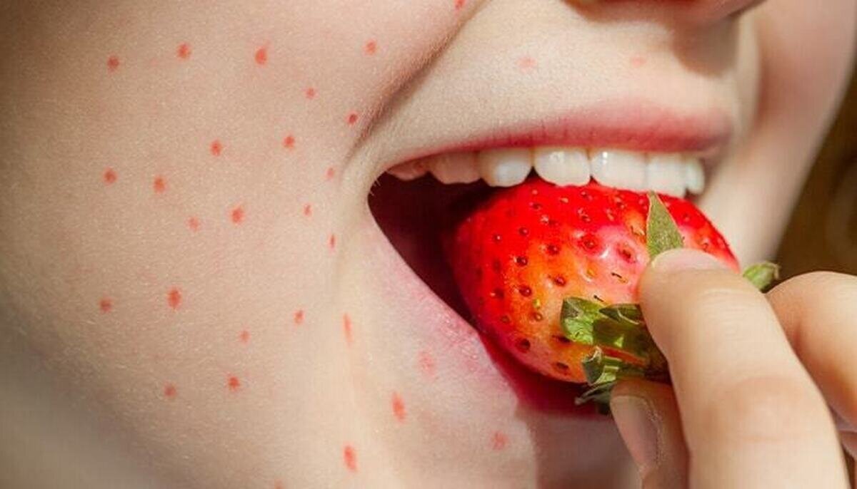 نشانه‌های آلرژی به توت فرنگی را بشناسید