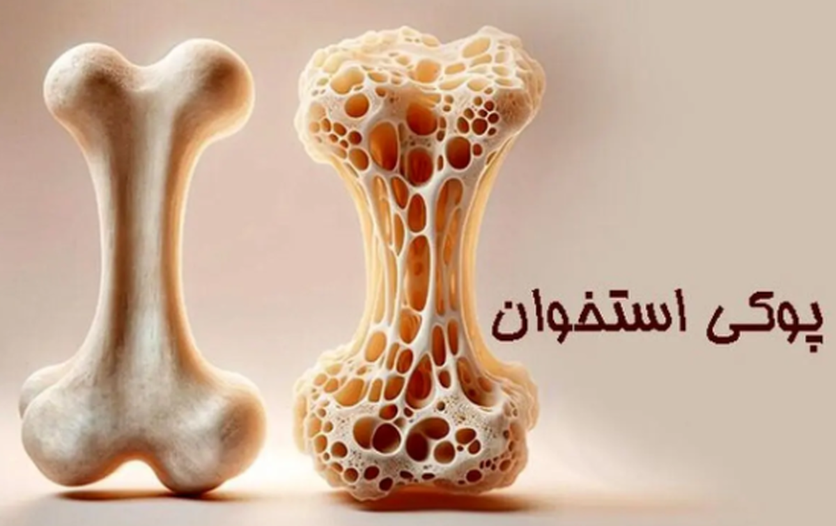 پوکی استخوان به جنسیت ارتباط دارد؟