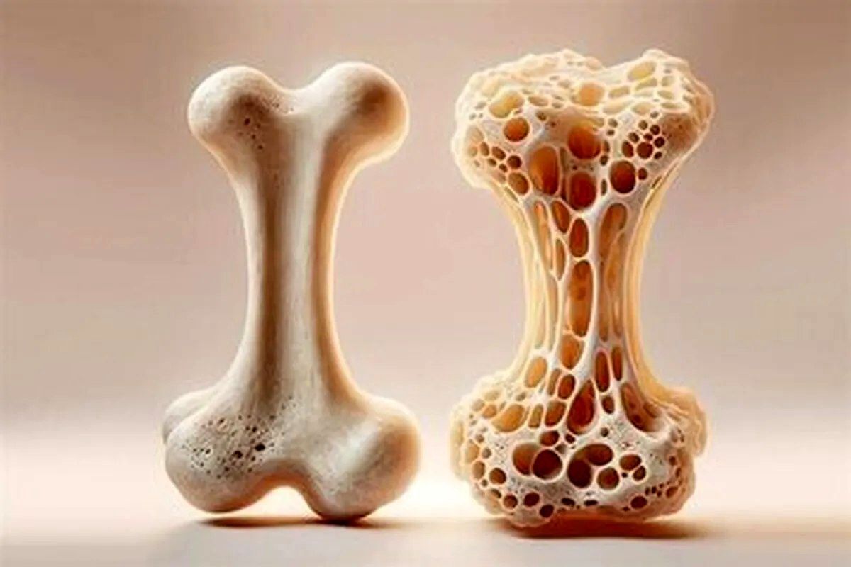 بیماری پوکی استخوان چه علتی دارد؟
