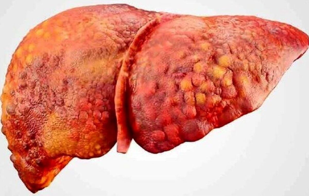 آینده افراد مبتلا به کبد چرب به کجا ختم می‌شود؟