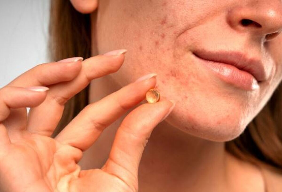 بررسی علمی تاثیر استامینوفن بر جوش صورت و رد جوش/استفاده کنیم یا نه؟