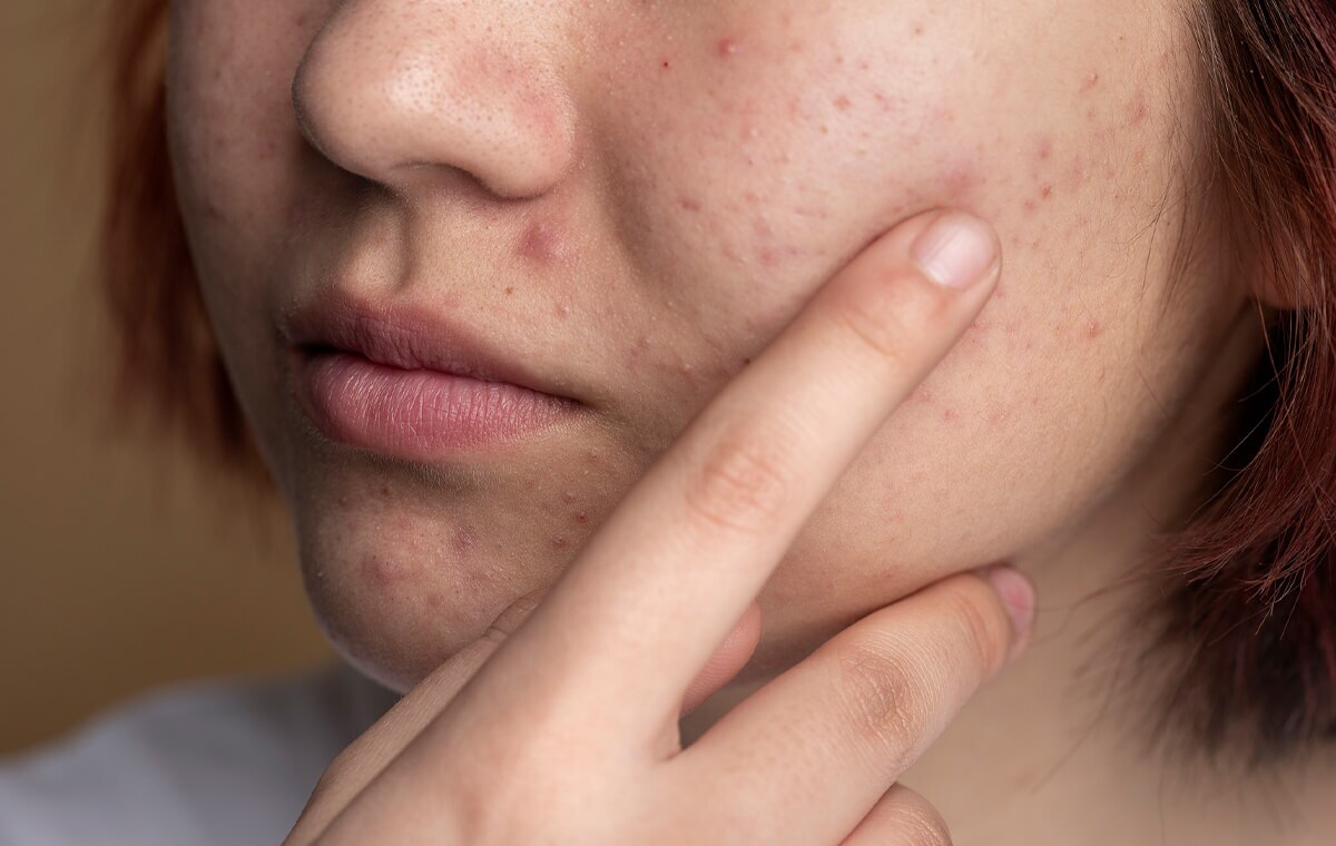 بررسی علمی تاثیر استامینوفن بر جوش صورت و رد جوش/استفاده کنیم یا نه؟