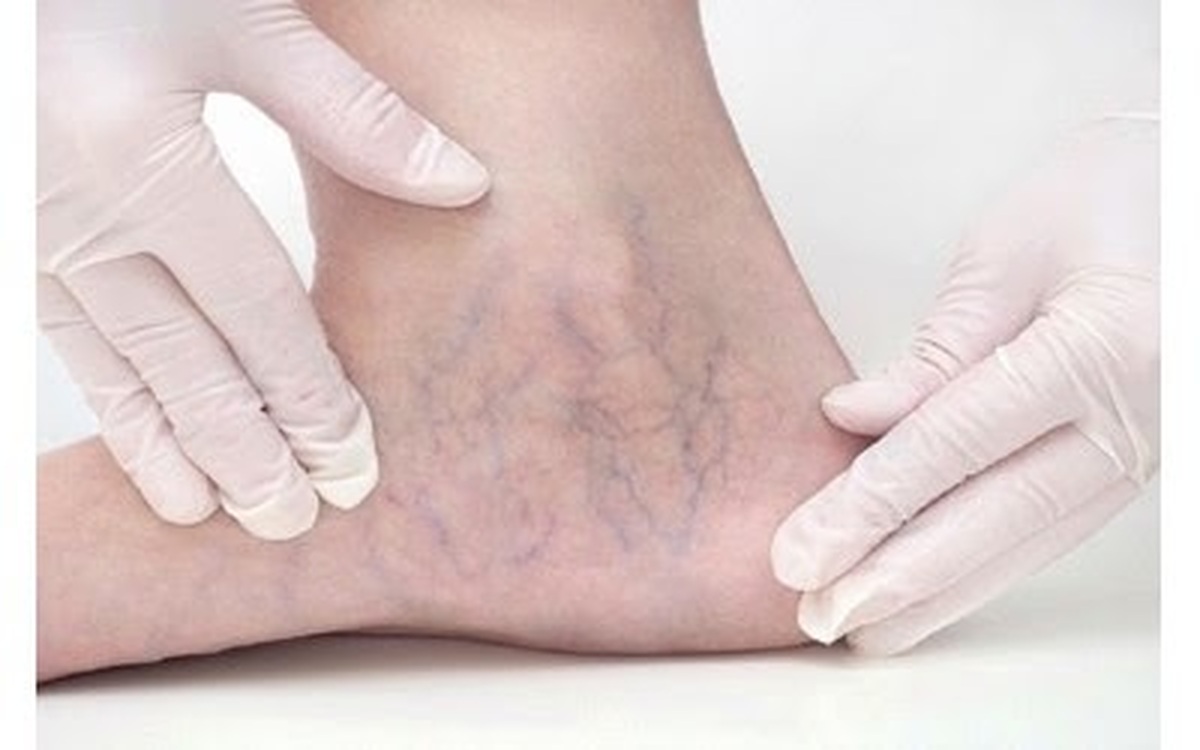 مطالعه ارتباط غیرمنتظره بین رگ‌های واریسی و مشکلات حافظه را نشان می‌دهد