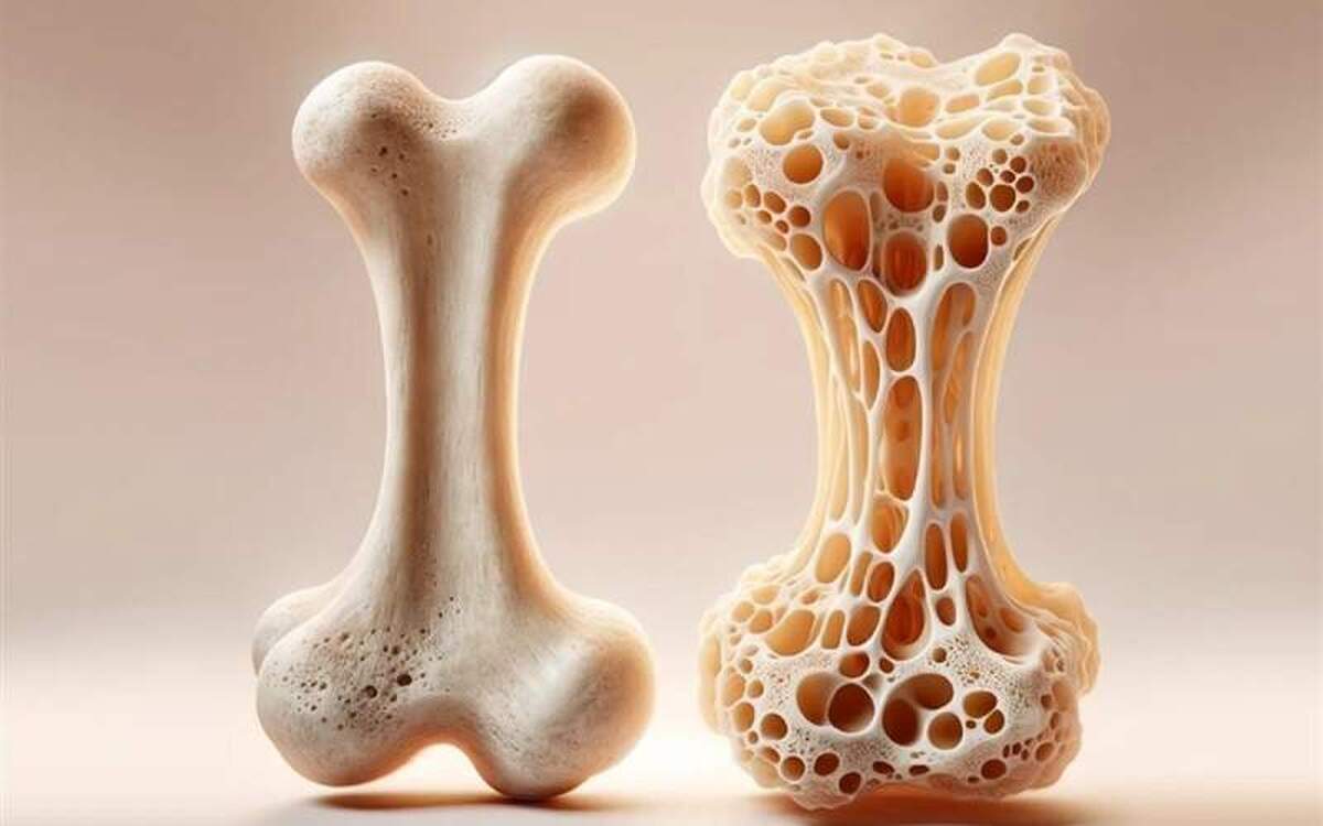 بررسی ارتباط بین چاقی و پوکی استخوان