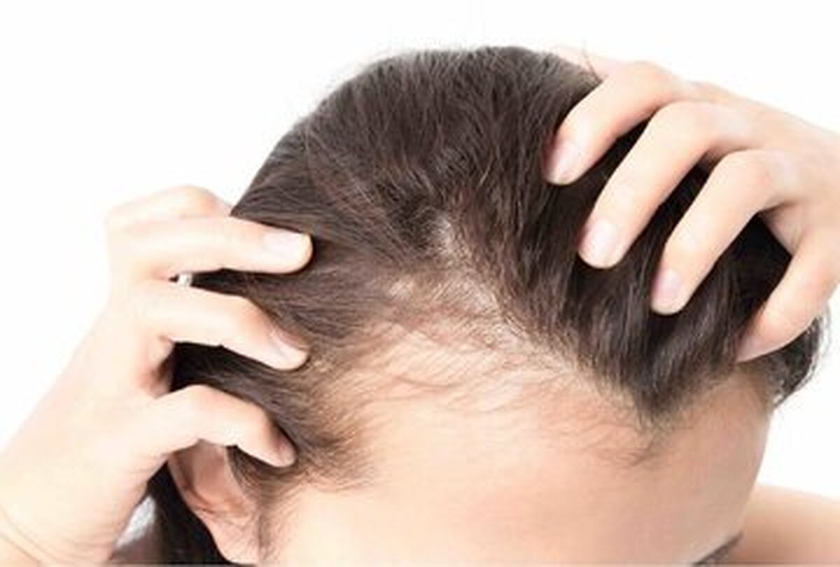 مصرف ماینوکسیدیل ریزش مو را بدتر می‌کند؟