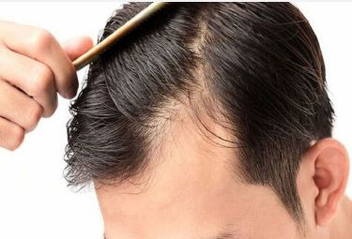 چگونه از شر ریزش مو خلاص شویم؟