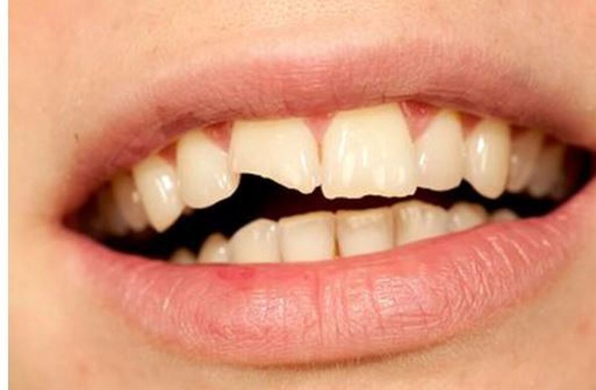 بررسی علل پوسیدگی مکرر دندان‌ها