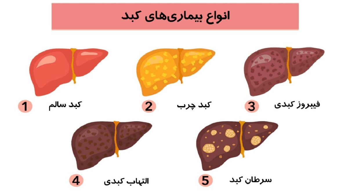 انواع کبد چرب را بشناسید!