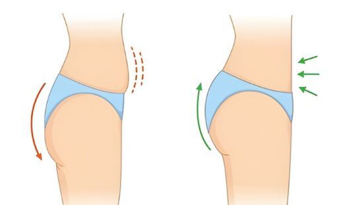 مزایا و معایب تزریق چربی به باسن +نکات مراقبتی