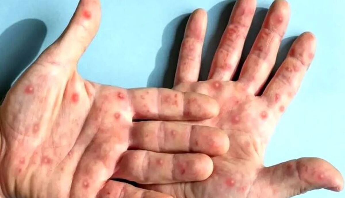علائم و خطرات این بیماری در بزرگ سالی چندین برابر بیشتر می‌شود