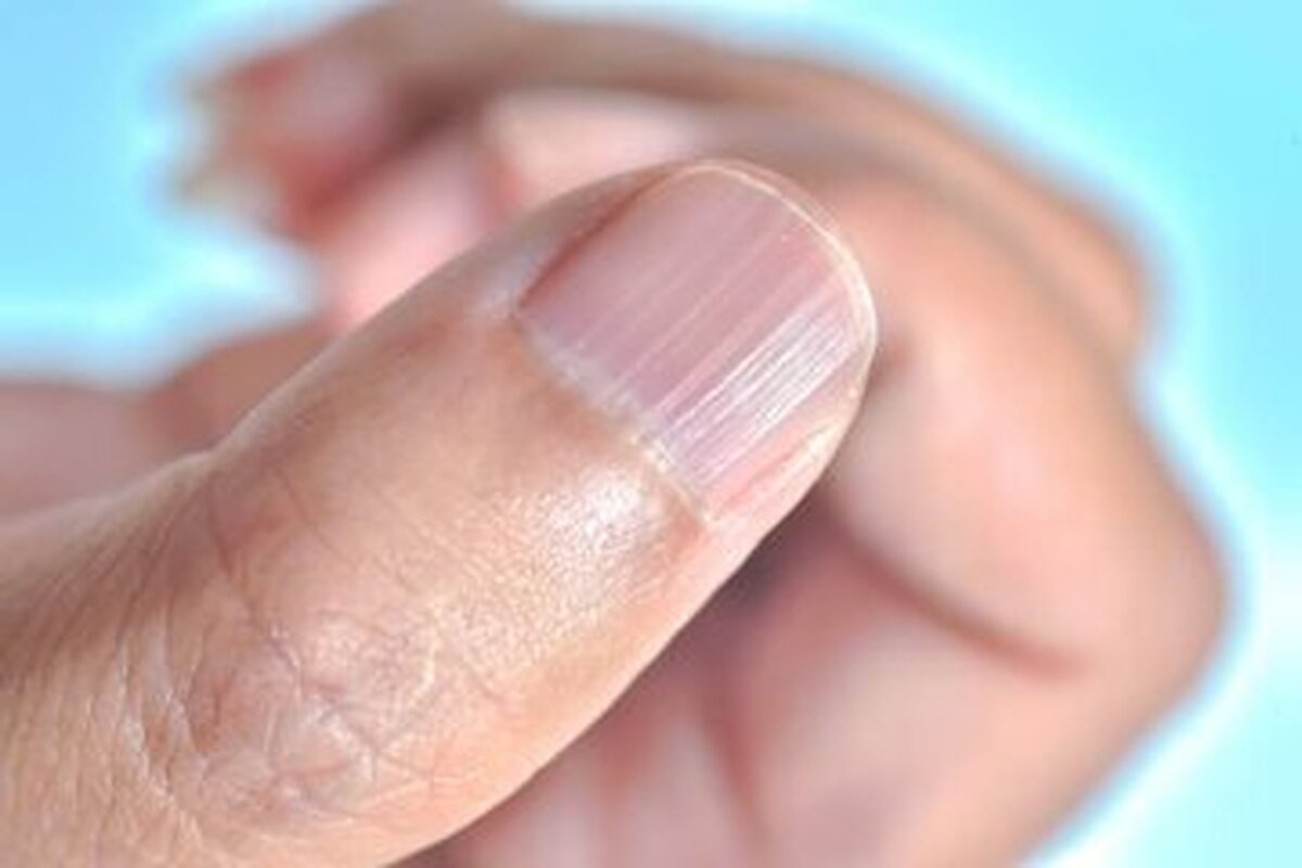 بروز حساسیت های شدید در پی استفاده از ژل های ناخن