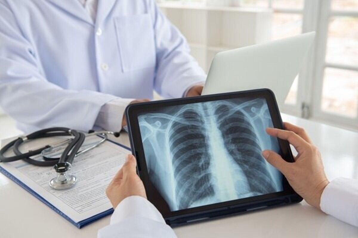 بررسی علل تجمع مایع در اطراف ریه‌ها