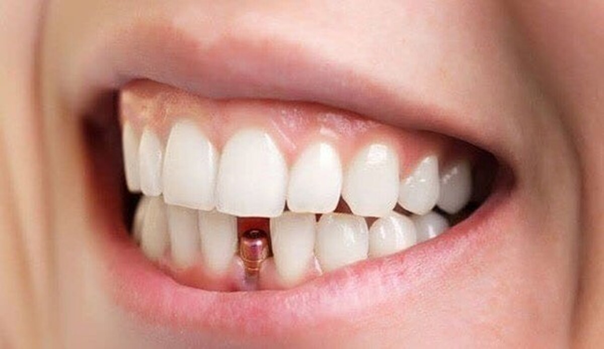 بهترین و جدید‌ترین روش برای جایگزینی دندان چیست؟