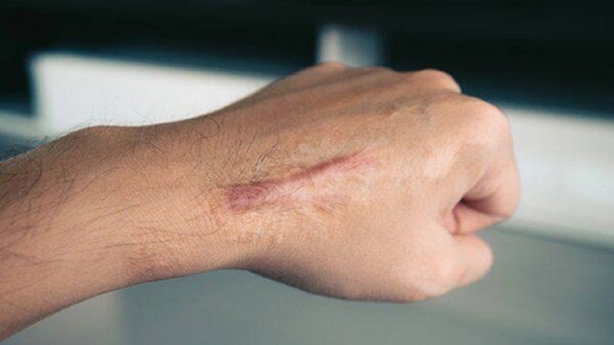 چگونه میتوان از کلوئید پیشگیری کرد؟
