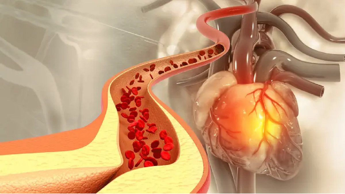 کاهش سطح کلسترول LDL با تغذیه!