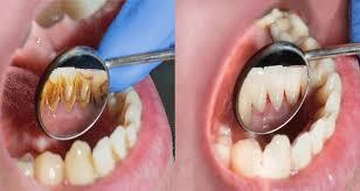 باور‌های نادرست درباره جرم گیری دندان ها!