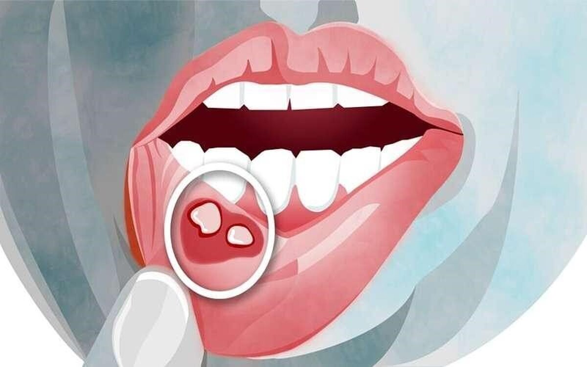 کاهش درد و تسریع بهبود آفت دهان در منزل