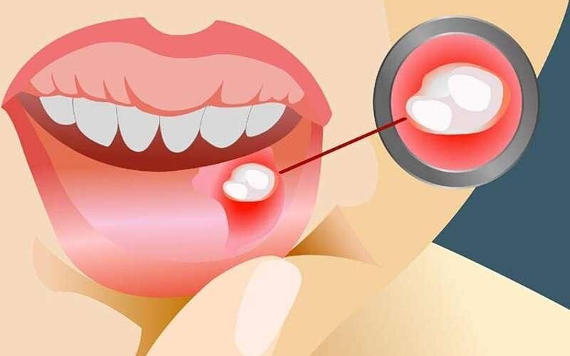 کاهش درد و تسریع بهبود آفت دهان در منزل