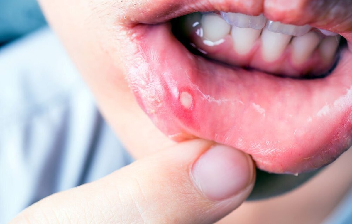 آفت دهان چرا ایجاد میشود؟