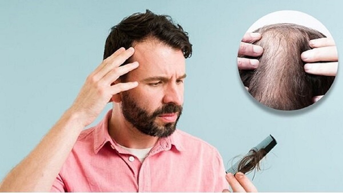 چگونه از پیشرفت ریزش مو سکه‌ای جلوگیری کنیم؟