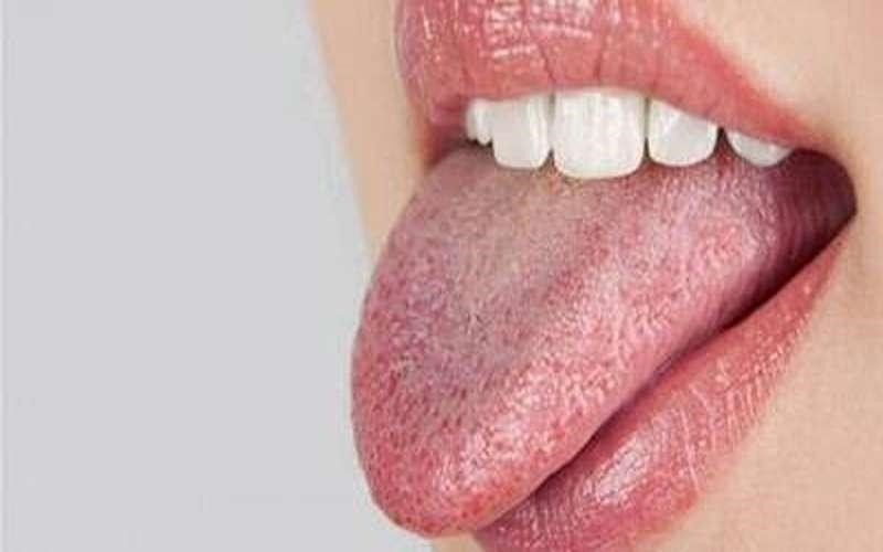 سفید شدن زبان؛ سرنخی از بیماری احتمالی در بدنتان!