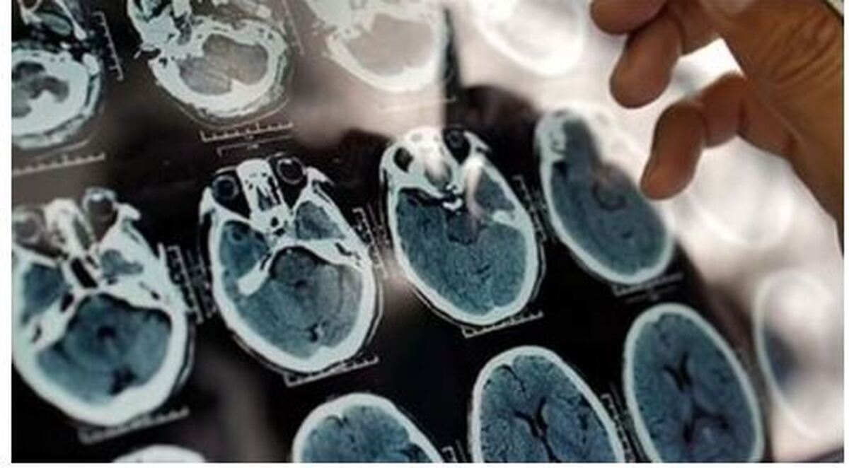 پیشگیری از آلزایمر با شناخت عوامل مؤثر در بروز