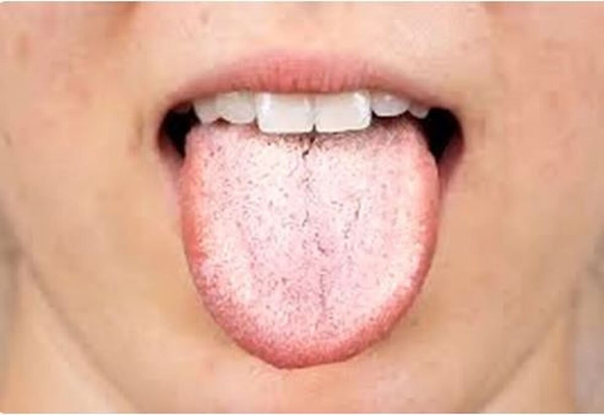 رنگ زبان، یک سرنخ از آنچه در بدنتان می‌گذرد!