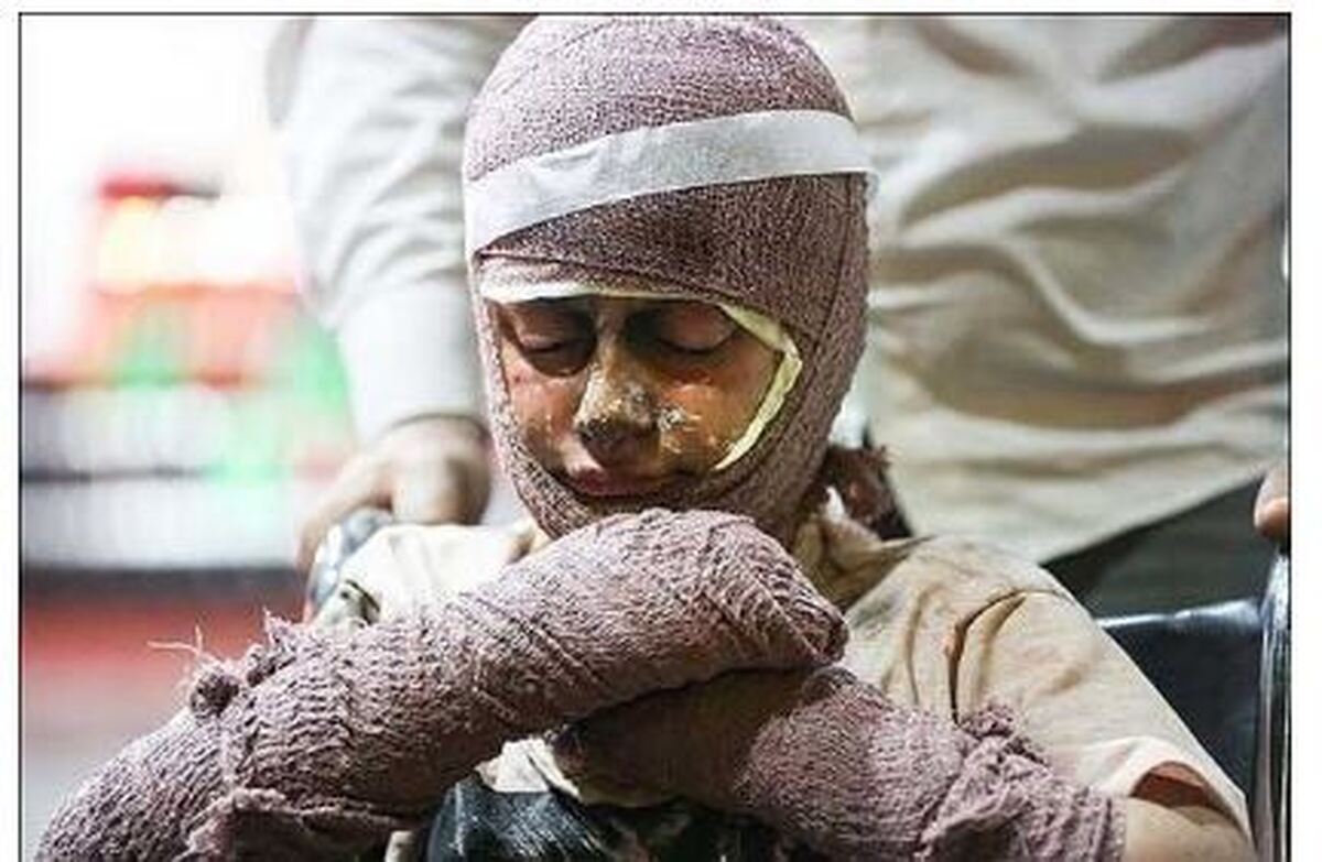 نوع و درجه سوختگی ناشی از جنگ را شناسایی کنید!