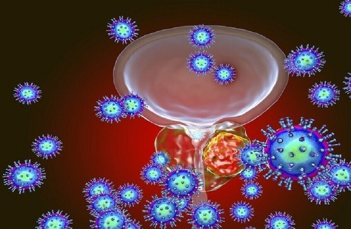 یک پزشک، افسانه‌های رایج در مورد هیپرپلازی خوش‌خیم پروستات (BPH) را رد می‌کند