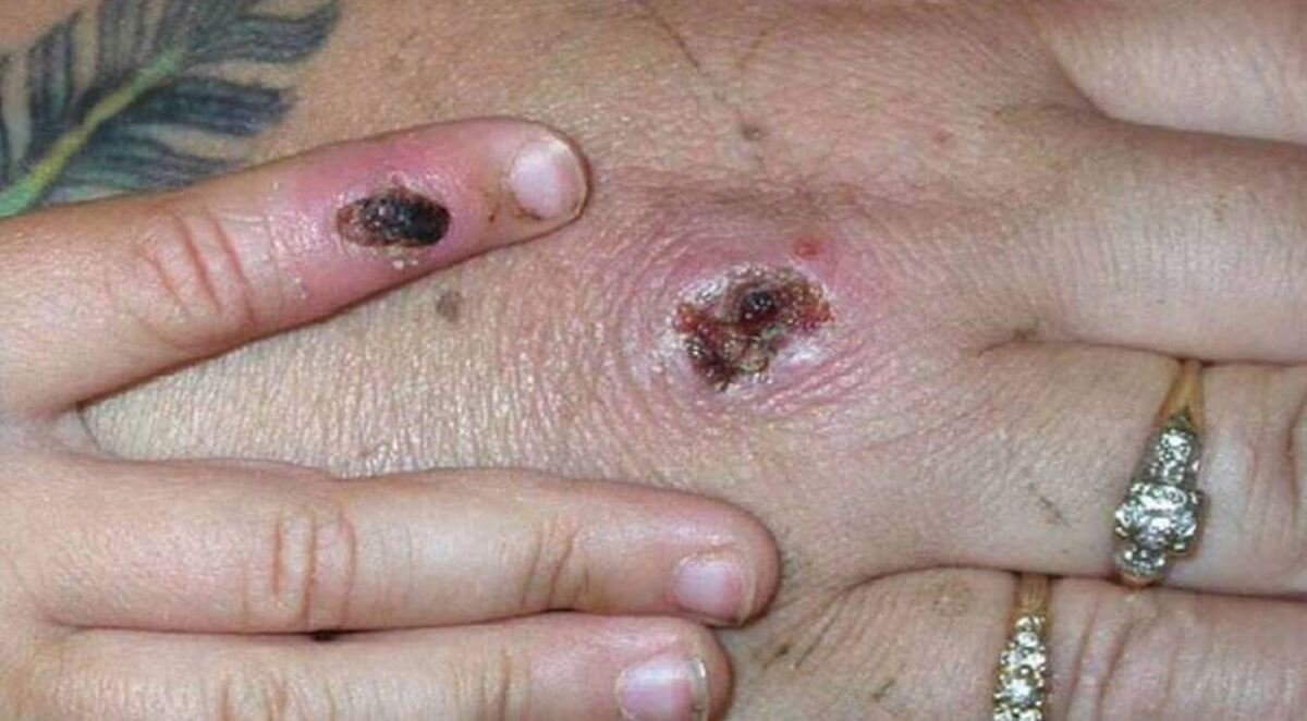 آبله میمونی، قبل از ظاهر شدن علائمش منتقل می‌شود!