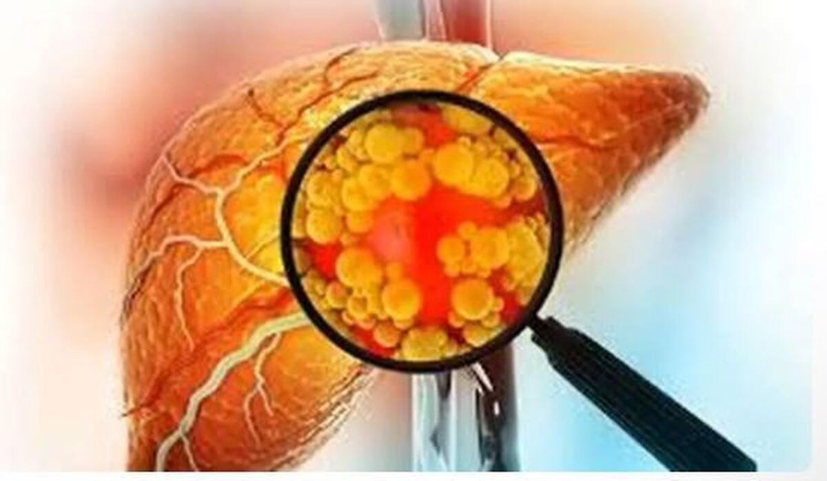 آیا می‌دانستید داشتن کبد چرب خطر ابتلا به بیماری‌های قلبی عروقی را افزایش می‌دهد؟