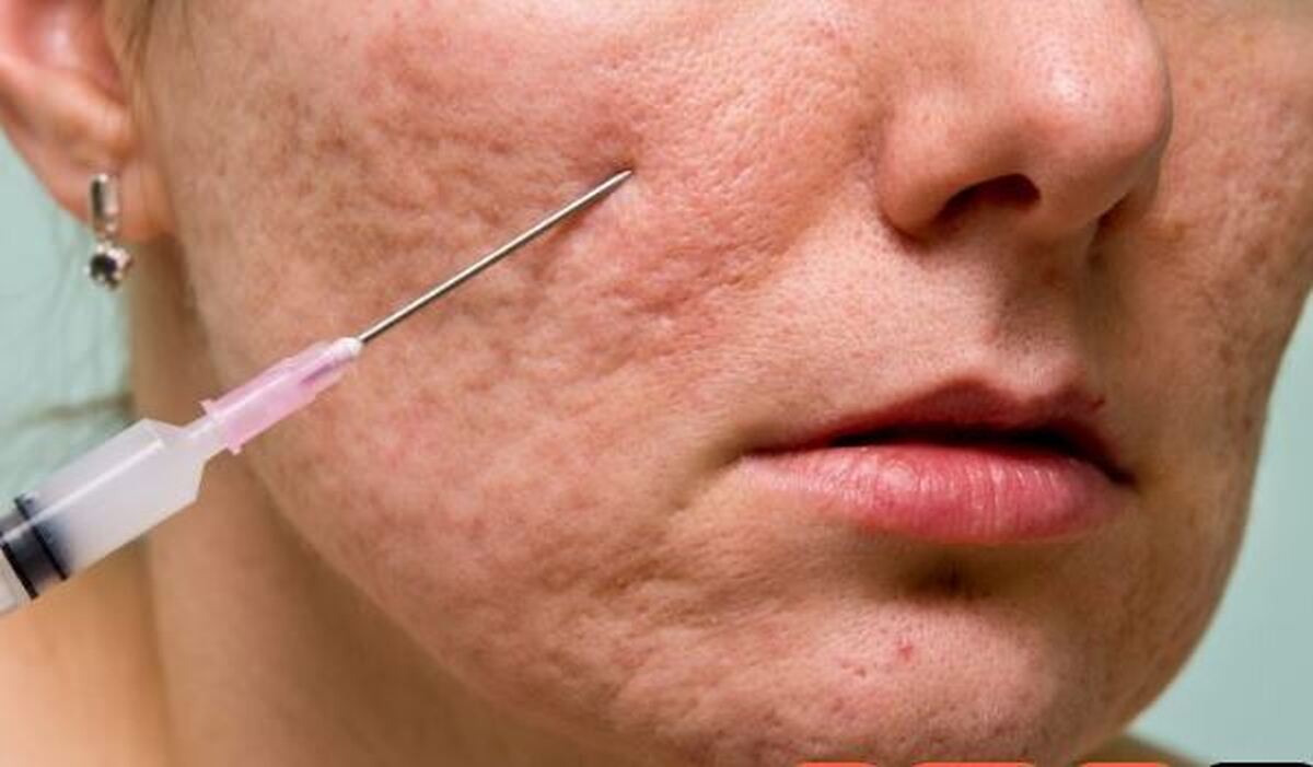 یک ترفند زیبایی برای رفع جوش‌های عمیق و فرورفتگی‌های پوستی /همه چیز درمورد سابسیژن پوست