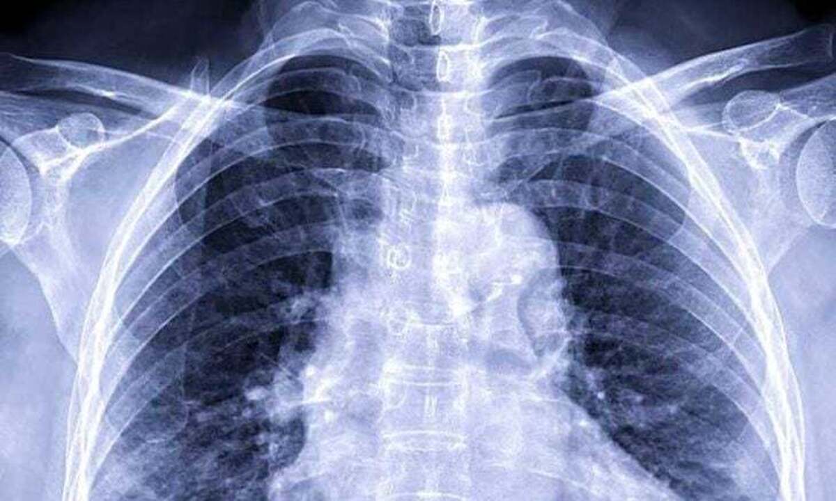 ۱۰ نکته پزشکی برای مقابله با شکستگی استخوان