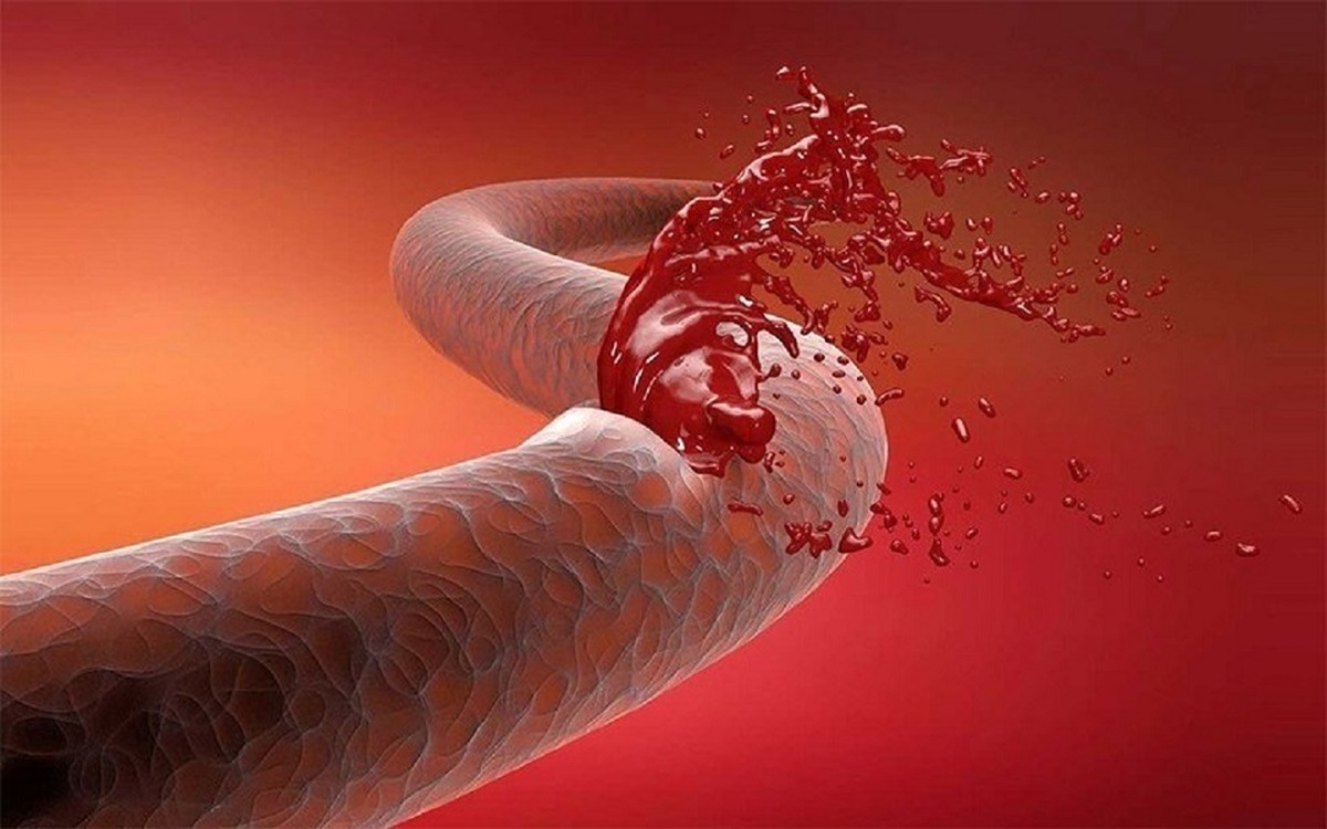 کنترل خونریزی با یادگیری نکات اولیه!